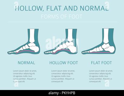 Types de déformation du pied, la maladie médicale infographie. Télévision, creux et pied normal. Vector illustration Illustration de Vecteur