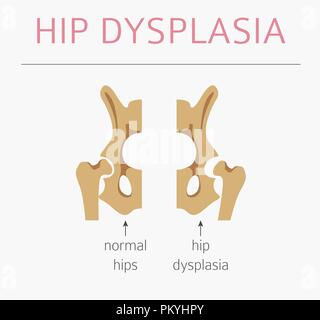 Types de déformation du pied, la maladie médicale infographie. La dysplasie de la hanche chez les enfants. Vector illustration Illustration de Vecteur