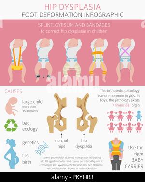 Types de déformation du pied, la maladie médicale infographie. La dysplasie de la hanche chez les enfants. Vector illustration Illustration de Vecteur