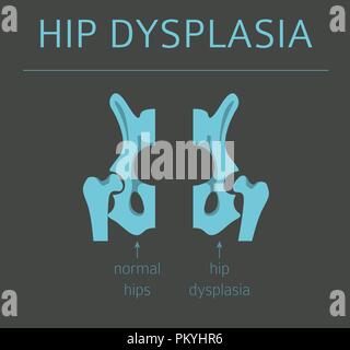 Types de déformation du pied, la maladie médicale infographie. La dysplasie de la hanche chez les enfants. Vector illustration Illustration de Vecteur