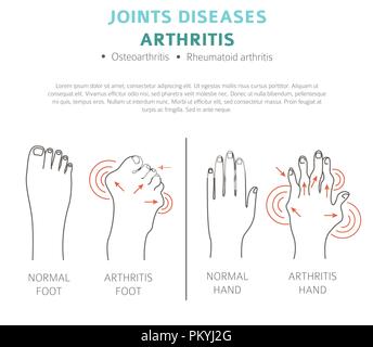 Des maladies des articulations. Les symptômes de l'arthrite, l'icône de traitement défini. Conception infographique médical. Vector illustration Illustration de Vecteur