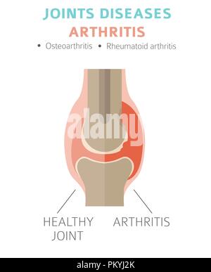 Des maladies des articulations. Les symptômes de l'arthrite, l'icône de traitement défini. Conception infographique médical. Vector illustration Illustration de Vecteur