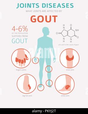 Des maladies des articulations. La goutte, symptômes, traitement icon set. Conception infographique médical. Vector illustration Illustration de Vecteur