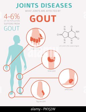 Des maladies des articulations. La goutte, symptômes, traitement icon set. Conception infographique médical. Vector illustration Illustration de Vecteur