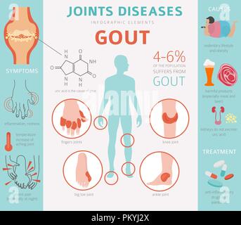 Des maladies des articulations. La goutte, symptômes, traitement icon set. Conception infographique médical. Vector illustration Illustration de Vecteur