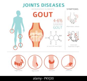 Des maladies des articulations. La goutte, symptômes, traitement icon set. Conception infographique médical. Vector illustration Illustration de Vecteur