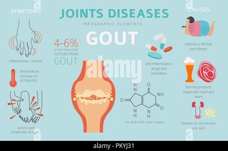 Des maladies des articulations. La goutte, symptômes, traitement icon set. Conception infographique médical. Vector illustration Illustration de Vecteur