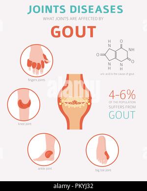 Des maladies des articulations. La goutte, symptômes, traitement icon set. Conception infographique médical. Vector illustration Illustration de Vecteur