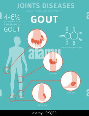 Des maladies des articulations. La goutte, symptômes, traitement icon set. Conception infographique médical. Vector illustration Illustration de Vecteur