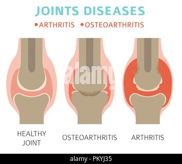 Des maladies des articulations. Les symptômes de l'arthrite, l'arthrose, l'icône de traitement défini. Conception infographique médical. Vector illustration Illustration de Vecteur