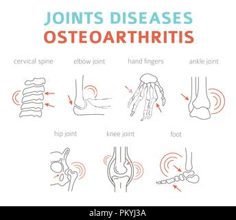 Des maladies des articulations. Les symptômes de l'arthrite, l'arthrose, l'icône de traitement défini. Conception infographique médical. Vector illustration Illustration de Vecteur