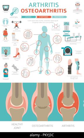 Des maladies des articulations. Les symptômes de l'arthrite, l'arthrose, l'icône de traitement défini. Conception infographique médical. Vector illustration Illustration de Vecteur