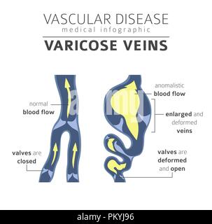 Les maladies vasculaires. Varices symptômes, traitement icon set. Conception infographique médical. Vector illustration Illustration de Vecteur