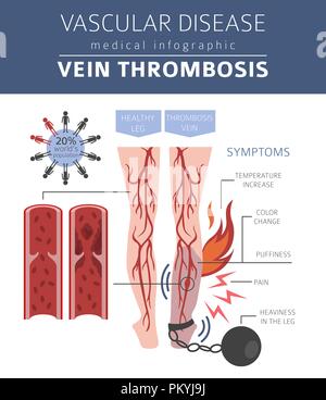 Les maladies vasculaires. Thromboses veineuses symptômes, traitement icon set. Conception infographique médical. Vector illustration Illustration de Vecteur