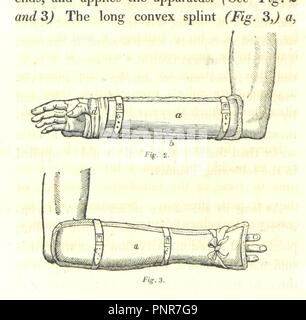 Libre à partir de la page 228 de "remarques pratiques sur la nature et le traitement des fractures du tronc et des extrémités, etc' . Banque D'Images