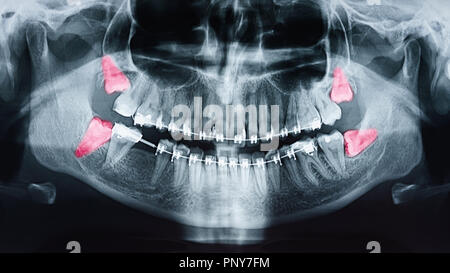 La douleur de plus en plus de dents de sagesse sur X-Ray Banque D'Images