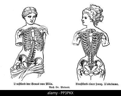 Poitrine de la Vénus de Milo (à gauche) et le thorax d'une dame française de la mode (à droite), endommagé par le port d'un corset. Après que M. Meinert, 1905 Banque D'Images