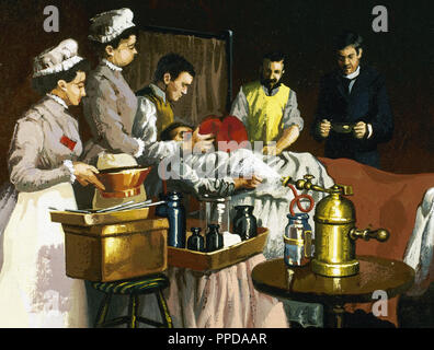 MORTON GREEN, William Thomas (1819-1868). Dentiste américain, qui a le premier utilisé avec succès en tant qu'éther anesthésique en chirurgie. Représentation d'une intervention à l'hôpital Bellevue à New York en 1870. Le patient a été opéré sans anesthésie à l'éther et de désinfection, connu pour la première fois le 16 octobre 1846. Banque D'Images