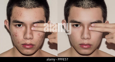 Jeune homme avec avant et après le traitement de l'acné et boutons, avant et après de traiter la peau du visage par des cicatrices et des rides par l'acné la dépose. La peau taches b Banque D'Images