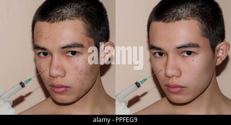 Jeune homme avec avant et après le traitement de l'acné et boutons, avant et après de traiter la peau du visage par des cicatrices et des rides par l'acné la dépose. La peau taches b Banque D'Images