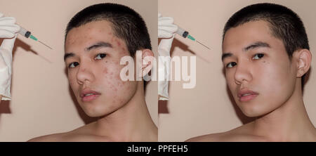 Jeune homme avec avant et après le traitement de l'acné et boutons, avant et après de traiter la peau du visage par des cicatrices et des rides par l'acné la dépose. La peau taches b Banque D'Images