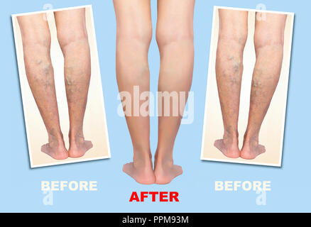 Traitement des varices essentielles avant et après. Varices sur les jambes. Banque D'Images