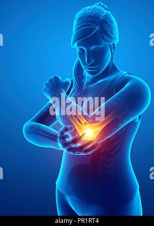 Femme avec la douleur du coude, illustration de l'ordinateur. Banque D'Images