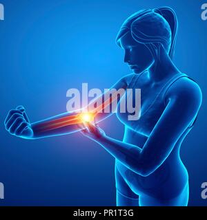 Femme avec la douleur du coude, illustration de l'ordinateur. Banque D'Images