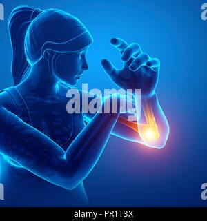 Femme avec la douleur du coude, illustration de l'ordinateur. Banque D'Images