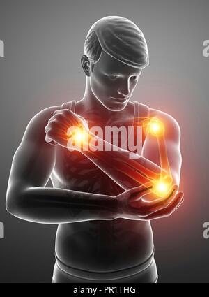 Homme avec des douleurs au bras, illustration de l'ordinateur. Banque D'Images