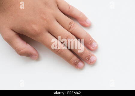 Les doigts de l'enfant de près avec la peau sèche, l'Eczéma dermatite. La médecine et les soins de concept. Banque D'Images