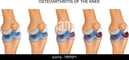Vector illustration de l'arthrose du genou Illustration de Vecteur