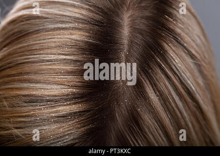 Close-up of a pellicules dans les cheveux blonds de Femme Banque D'Images