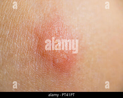 Insecte morsure sur la peau des femmes Banque D'Images