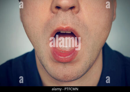 Comprimé à sucer pour mal de gorge dans la bouche. Un jeune homme malade avec le SRAS ou la grippe ou le rhume menthe pour une haleine fraîche. close - up d'ouvrir la bouche. Banque D'Images