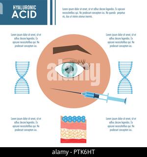 L'acide hyaluronique injection de remplissage infographie Illustration de Vecteur