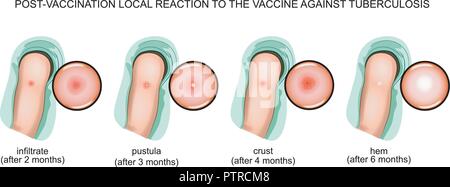 Vector illustration d'après vaccination réactions au vaccin contre la tuberculose Illustration de Vecteur