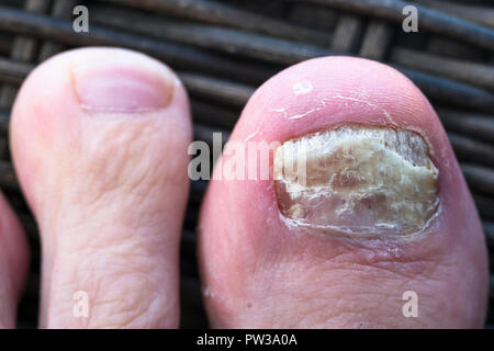 L'infection fongiques des ongles sur les pieds. Banque D'Images