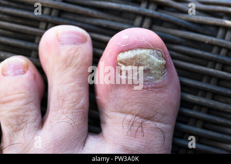 L'infection fongiques des ongles sur les pieds. Banque D'Images