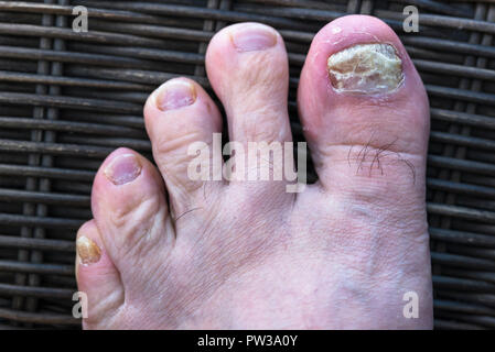 L'infection fongiques des ongles sur les pieds. Banque D'Images