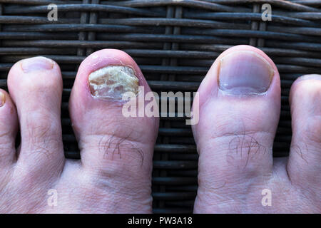 L'infection fongiques des ongles sur les pieds. Banque D'Images