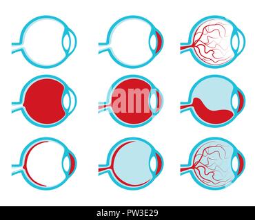 Des yeux humains sains et malsains side view Illustration de Vecteur