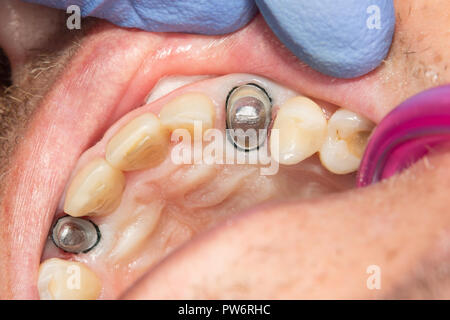 Close-up de l'ensemble de la dent avec une broche, est préparé par la fraise sous la couronne de la dent. Le concept de restauration de l'orthopédie de la perte des dents à l'utilisation Banque D'Images