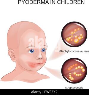 Illustration vecteur de la pyodermite. Streptococcus, Staphylococcus Illustration de Vecteur