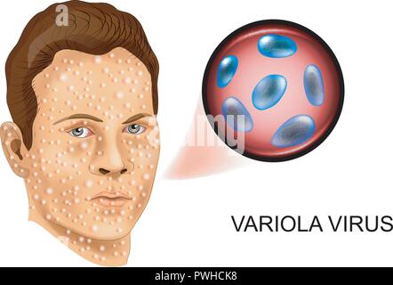 Illustration vecteur du virus de la variole. La défaite du visage Illustration de Vecteur