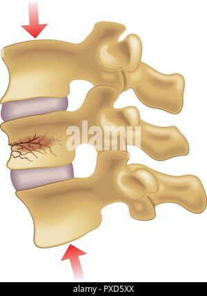 Vector illustration médicale des symptômes d'une fracture par tassement vertébral Illustration de Vecteur