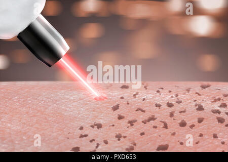 Procédure de cosmétologie rousseur laser peau dépose sur les parties du corps. close up Banque D'Images