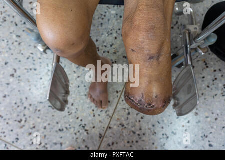 Amputation au-dessous du genou gauche, moignon de patient avec diabète post opération amputé Banque D'Images