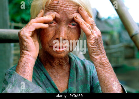 Portrait of elderly woman touching her face albinos dans un village éloigné, Sumbawa Sumbawa, Village, Indonésie Banque D'Images