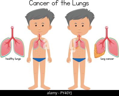 Le cancer des poumons illustration Illustration de Vecteur